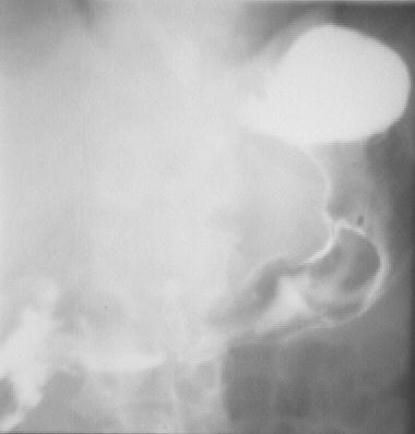 gastric atrophy with carcinoma722-3211-1240320.jpg